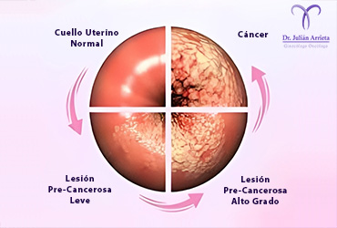 Cáncer de cuello uterino